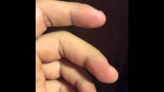 Major fasciculation in middle finger  Muscle twitching [upl. by Merrili]