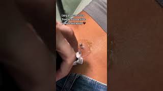 Piercing Migration Treatment  Piercing Bump Removal ft Base Laboratories Piercing Bump Treatment [upl. by Dorotea]