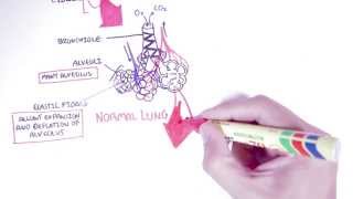 Emphysema  Introduction Types Symptoms Diagnosis [upl. by Gustie]