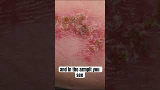 Bacterial Skin Infection Painful Sores [upl. by Nanon936]