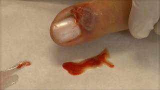 Incision and Drainage of a Paronychial near the nail bed abscess [upl. by Nelrah223]