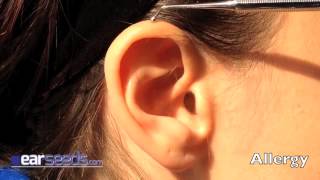 Allergy Auriculotherapy Ear Point [upl. by Glennis]