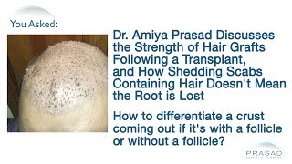 Why Dislodged Scabs Containing Hair After a Hair Transplant Doesnt Mean That Hair Grafts are Lost [upl. by Aieken]