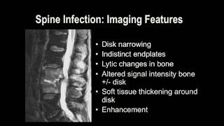 Understanding Basic MRI of the Spine [upl. by Laumas]