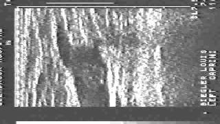 Unstable Femoral Vein Thrombus [upl. by Low988]