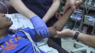 Posterior Elbow Dislocation Reduction [upl. by Ano]