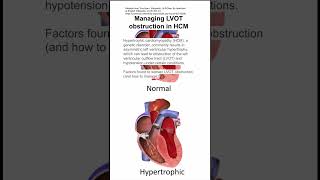 Managing left ventricular outflow tract LVOT obstruction in hypertrophic cardiomyopathy HCM [upl. by Myer]