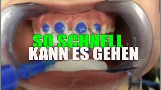 SO SCHNELL wird die FESTE ZAHNSPANGE eingesetzt  Orthodentix [upl. by Syla]