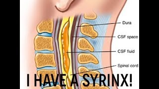 I have Syringomyelia  cyst in spinal chord [upl. by Adnalohs]