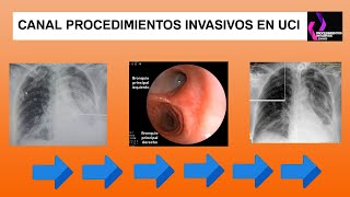 Broncoscopia aspiración y lavado bronquio alveolar para solucionar atalectasia [upl. by Budwig]