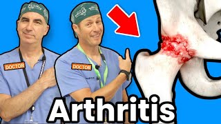 Treating Hip Arthritis Without Surgery [upl. by Dreddy]