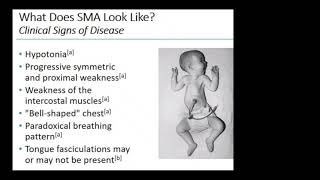 whats classic triads of SMA spinal muscle atrophy Hypotonia hyporeflexia tongue fasciculation [upl. by Naras778]