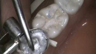 Class II amalgam with audio [upl. by Eeb]