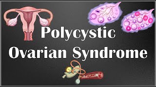 Polycystic Ovarian Syndrome PCOS  Causes Signs amp Symptoms Diagnosis amp Treatment [upl. by Patsis777]