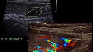 TMT Neck Ultrasound Parathyroid Nodule [upl. by Aneela]