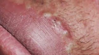 Blackheads amp Whiteheads Satisfying Removal 0137 [upl. by Aseyt]