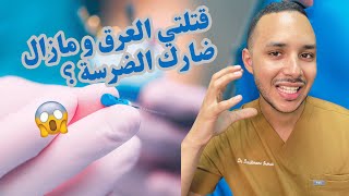 قتلتي العرق و مازال ضارك الضرسة ؟واش عادي أو لا؟ [upl. by Anegroeg]