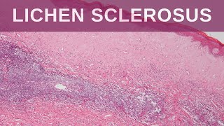 Lichen Sclerosus  Pathology mini tutorial [upl. by Chapnick]