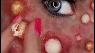 Popping Huge Pimples Filled with Pus  Satisfying SFX Zit Pops Sickness Warning [upl. by Nyrhtak]