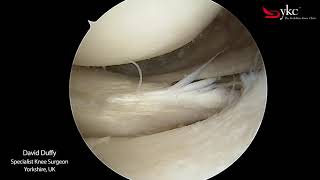 Watch a Knee Surgeon Treat a Meniscal Tear [upl. by Airolg]