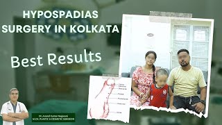 Hypospadias Surgery In Kolkata  Hypospadias Problem amp Solution  Best Result [upl. by Cirdnek834]