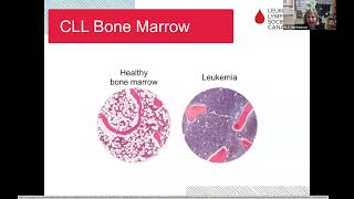 Chronic lymphocytic leukemia CLL What it is when to treat and what’s ahead [upl. by Gaby]