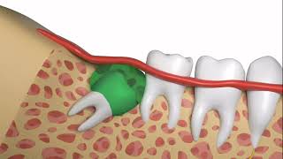 How To Safely and Quickly Have a Wisdom Tooth Extraction [upl. by Chere]