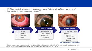 Understanding Vernal Keratoconjunctivitis VKC Not “Just an Allergy” [upl. by Trojan435]