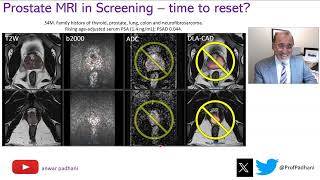 MRI in Prostate Cancer Screening  Time to Reset [upl. by Gilges]