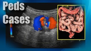 Cases  GI  Midgut Volvulus [upl. by Kenon489]