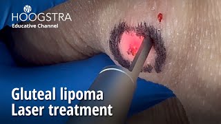 Gluteal lipoma  Laser treatment  24146 [upl. by Fokos]