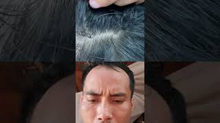 Omg😱😱😱007 hair licecomb headlice stitch nomorelice satisfying headliceremoval facelice [upl. by Aroda]