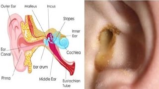 5 Home Remedies for Ear Discharge  Get Rid of an Ear Infection Fast  By Top 5 [upl. by Murat769]