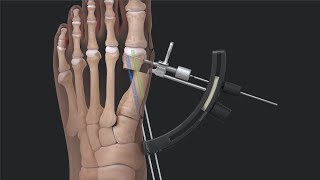 Arthrex Minimally Invasive Bunionectomy System Surgical Technique [upl. by Egor]