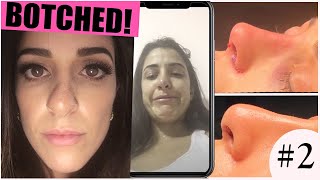 MY NOSE JOB REVISION RHINOPLASTY EXPERIENCE IN TURKEY  surgery day amp hospital tour  PART 2 [upl. by Turnheim]