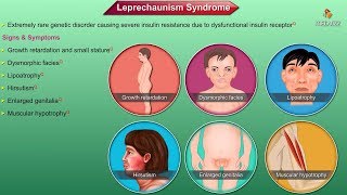 Leprechaunism  Donohue syndrome  Animation [upl. by Lizzy]