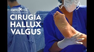 CIRUGÍA HALLUX VALGUS [upl. by Ahsemat]