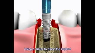 Dental implant procedure [upl. by Rennane49]