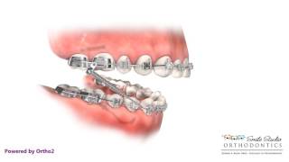 Headgear VS Forsus  Orthodontic Treatment [upl. by Rainie345]