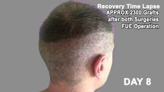 Hair Transplant Review 2013 19 DAY RECOVERY TIME LAPSE OF DONOR AREA POST OP [upl. by Idoj]