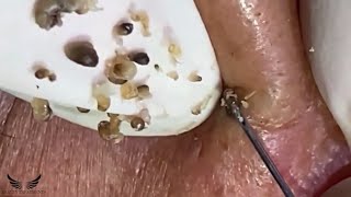 Cystic Acne Blackhead Removal  Elderly Hidden Acne Treatment  Pimple Popping Spa Extraction  060 [upl. by Durham]