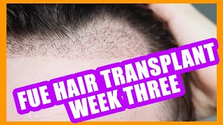 FUE Hair Transplant  Week 3  A brief update on progress  Hair Growth [upl. by Ahsot651]