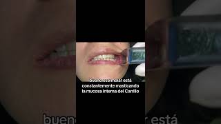 Remoción de fibroma traumático dentales dentalcondition cuidadodental dentist [upl. by Budwig267]