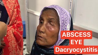 Abscess formation  Dacryocystitis  eye [upl. by Davida]