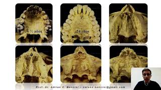 Comunicaciones Bucosinusales y Buconasales Cap 1Cirugia IIUCALP Prof Dr Adrian C Bencini  2020 [upl. by Olegnaleahcim]