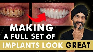 How we make a full set of Dental Implants all on 4 look great [upl. by Bat]