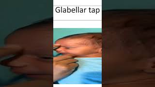 Glabellar Tap [upl. by Iror]