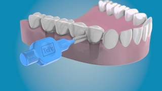 Limpie los laterales de sus implantes con un cepillo interdental TePe [upl. by Yorled]