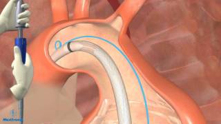 Thoracic Endovascular Aortic Aneurysm Repair in Dallas [upl. by Halilak]