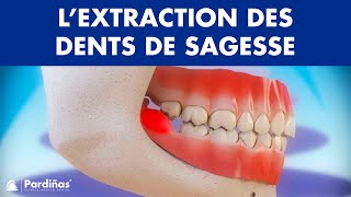 Extraction dune dent de sagesse [upl. by Zurek184]